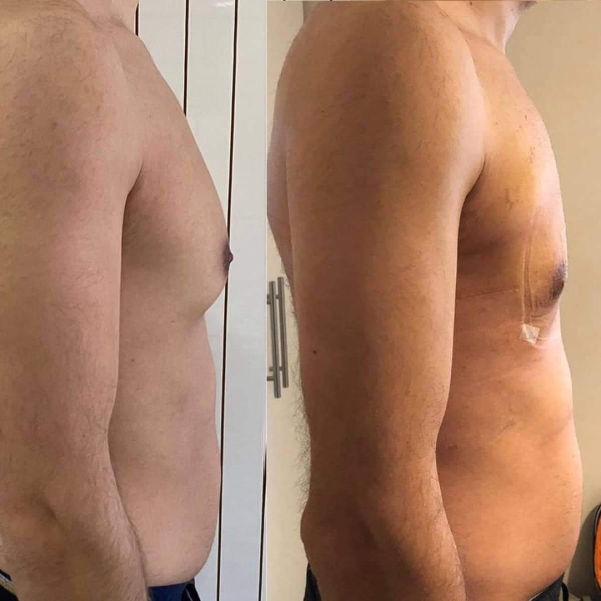 Case 11879 - gynecomastia surgery