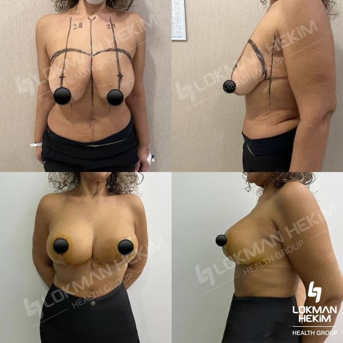 Case 11881 - breast lift