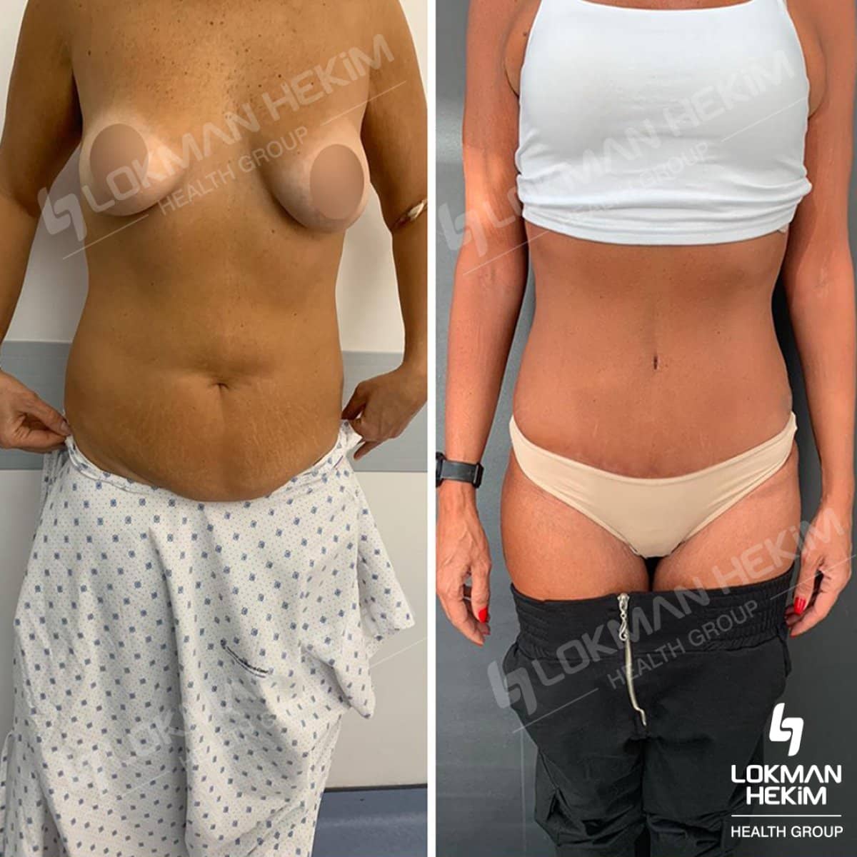Case 11884 - tummy tuck
