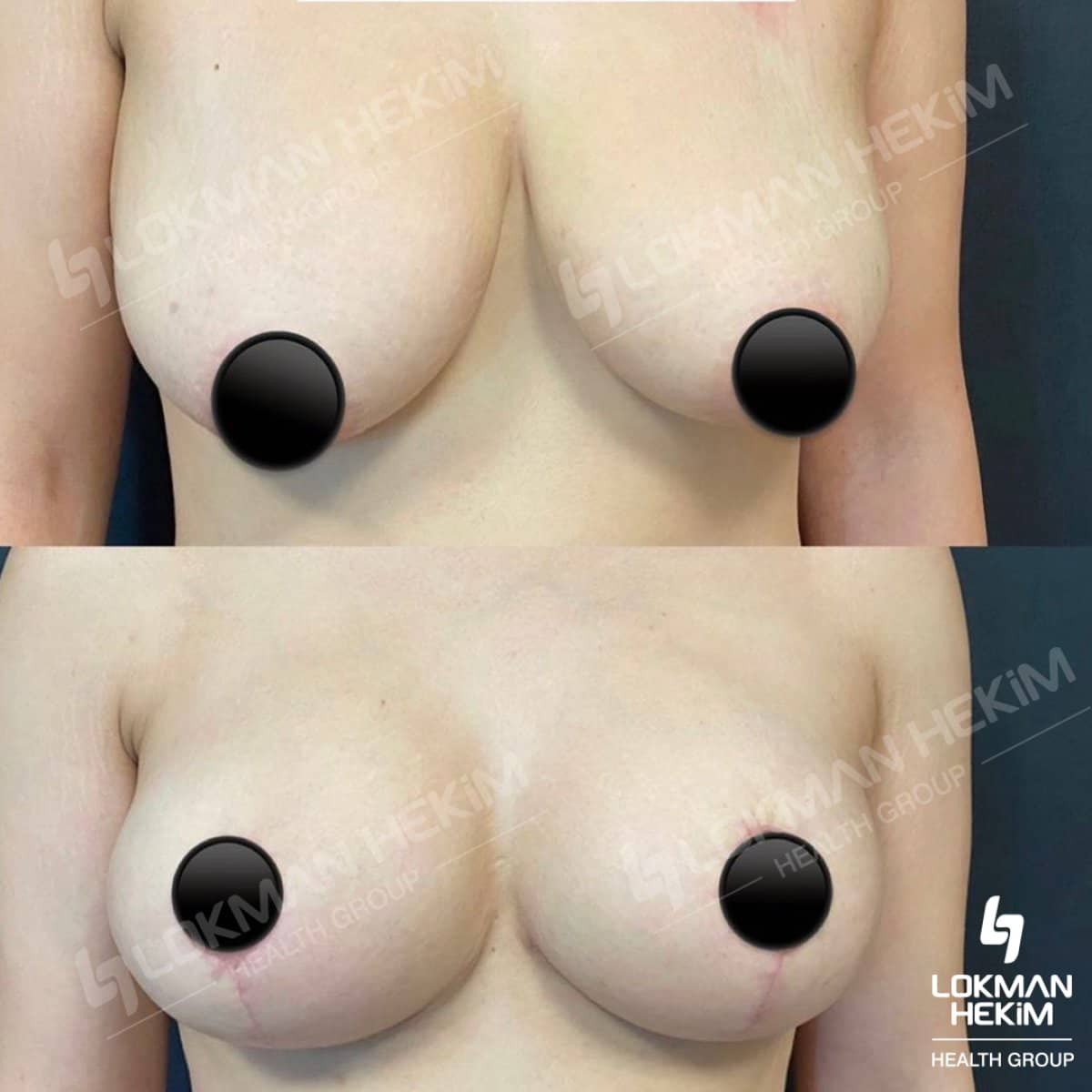 Case 11885 - tummy tuck