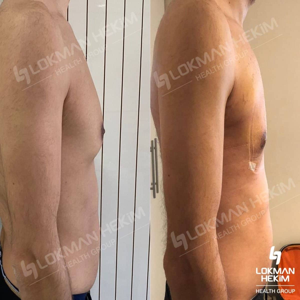 Case 11889 - gynecomastia surgery