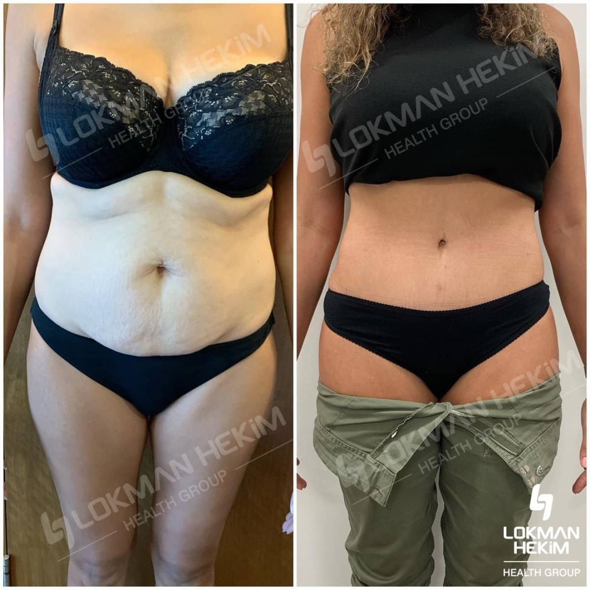 Case 11890 - tummy tuck