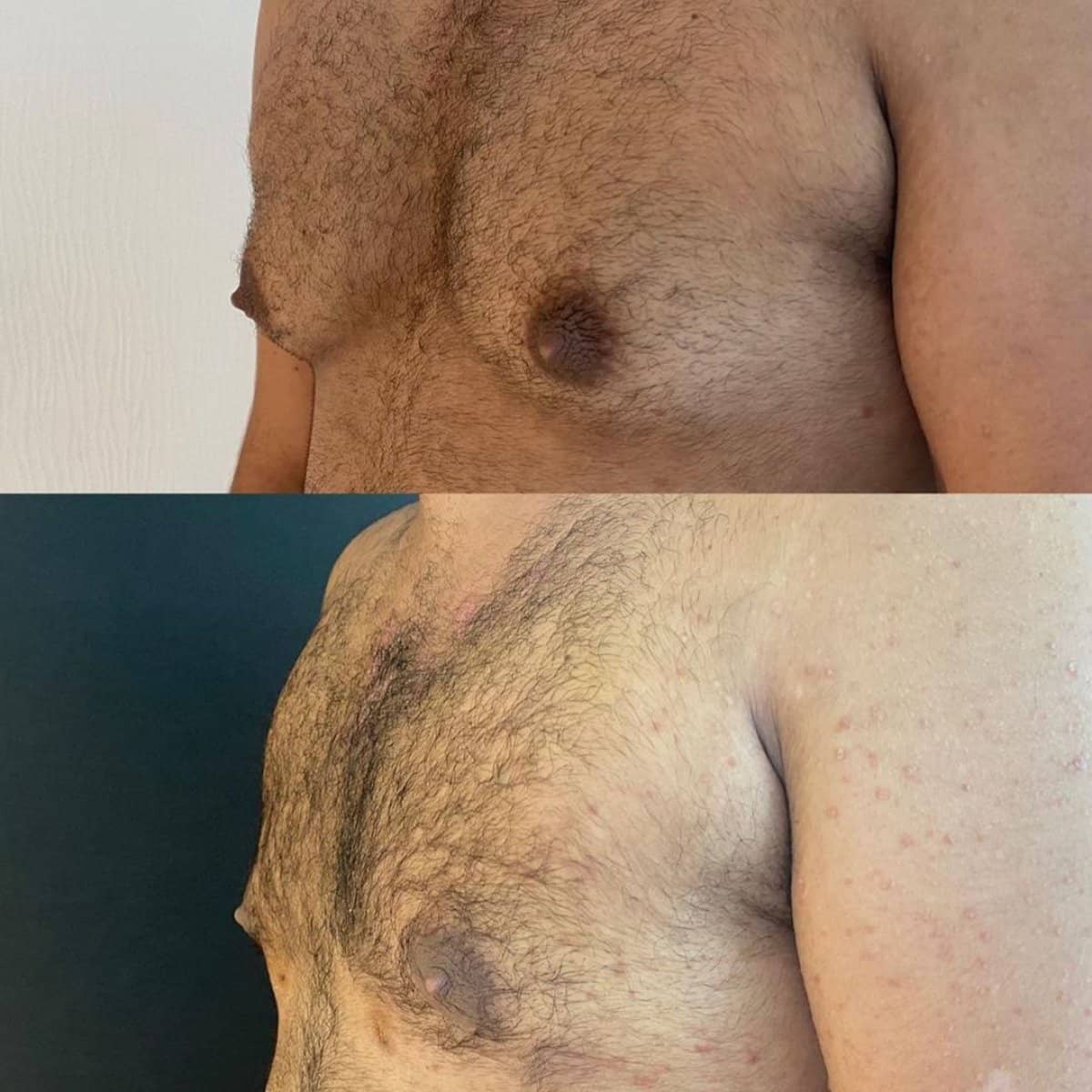 Case 11891 - gynecomastia surgery