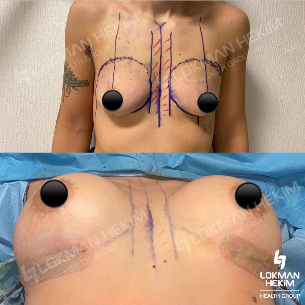 Case 11894 - gynecomastia surgery