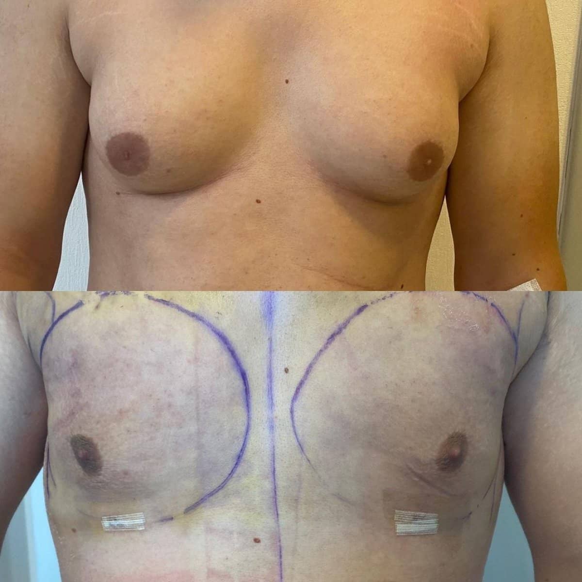 Case 11897 - blepharoplasty