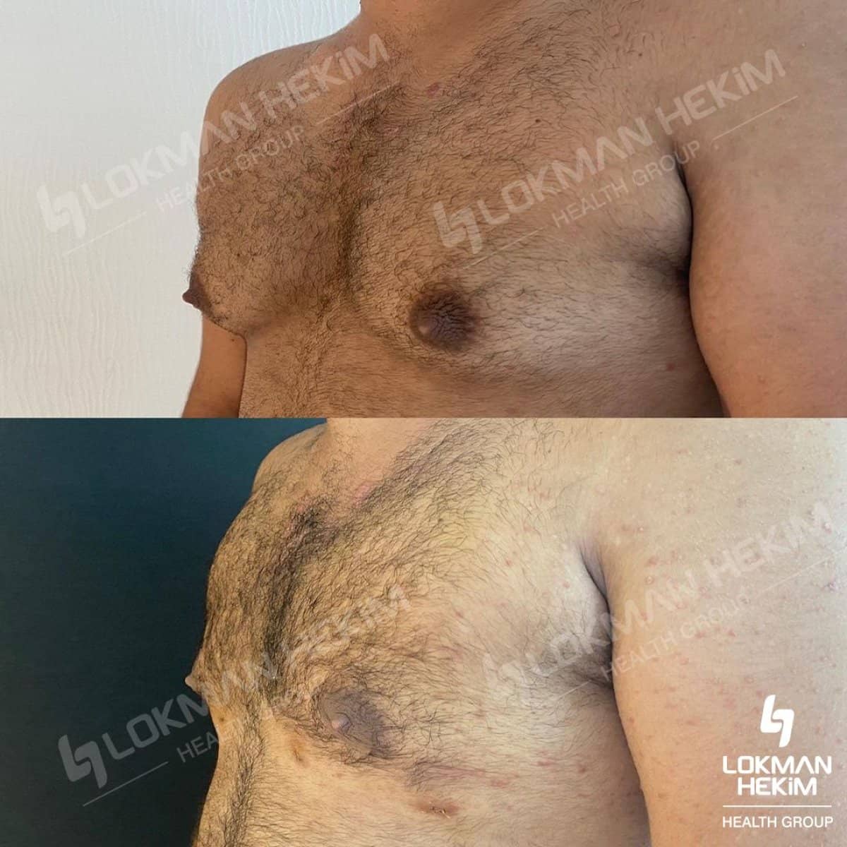 Case 11900 - breast augmentation