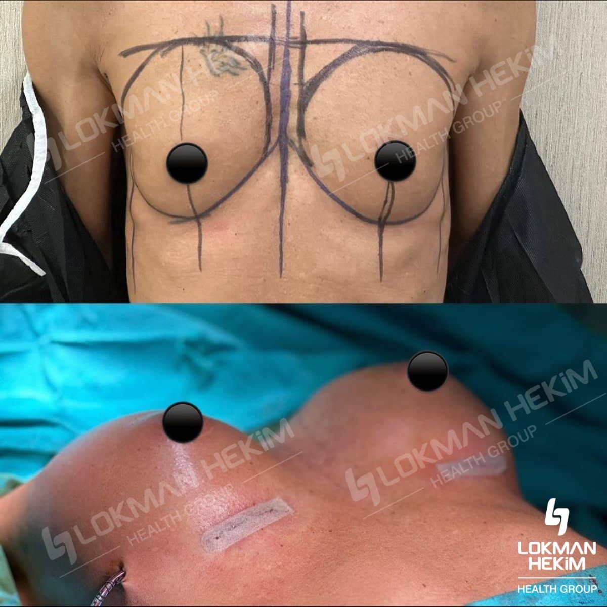 Case 11901 - blepharoplasty