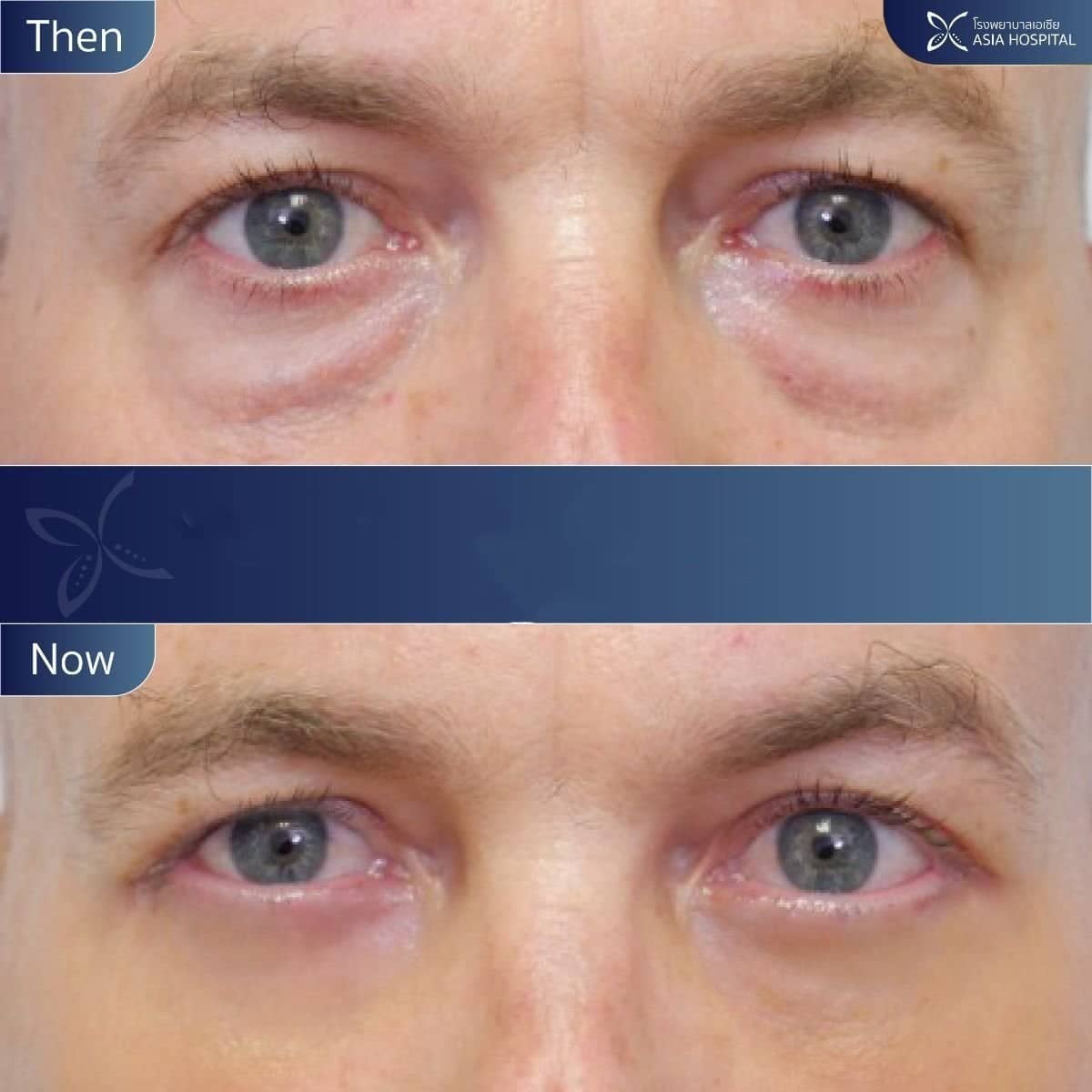 Case 11910 - lower eyelid blepharoplasty