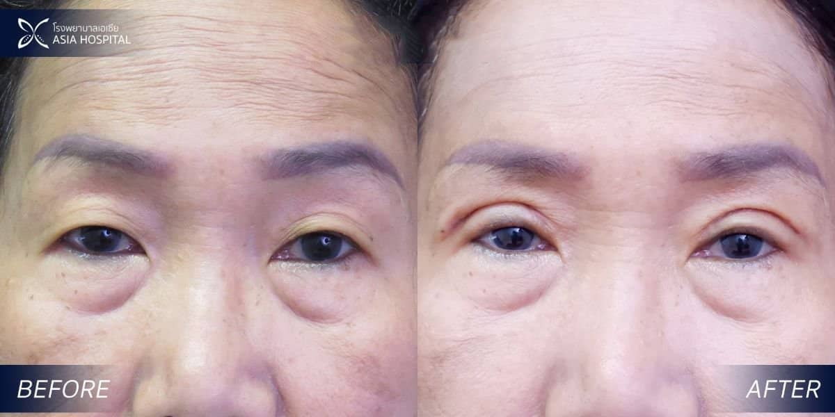 Case 11918 - upper and lower eyelid surgery