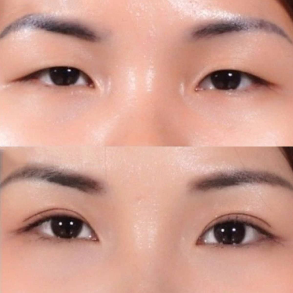 Case 11928 - upper eyelid surgery
