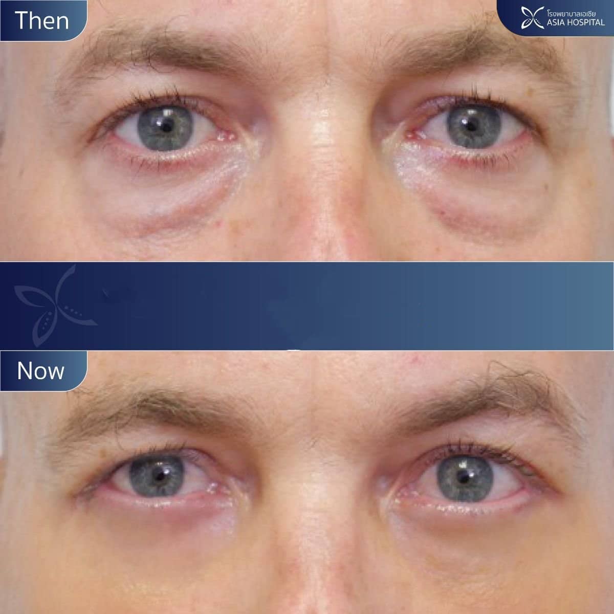 Case 11932 - upper and lower eyelid surgery