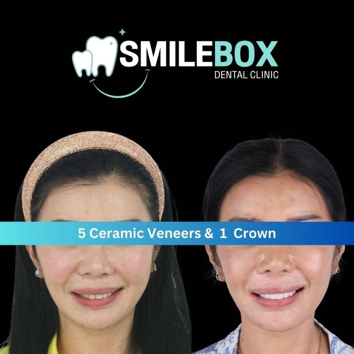 Case 11955 - result of 5 ceramic veneers and 1 crown