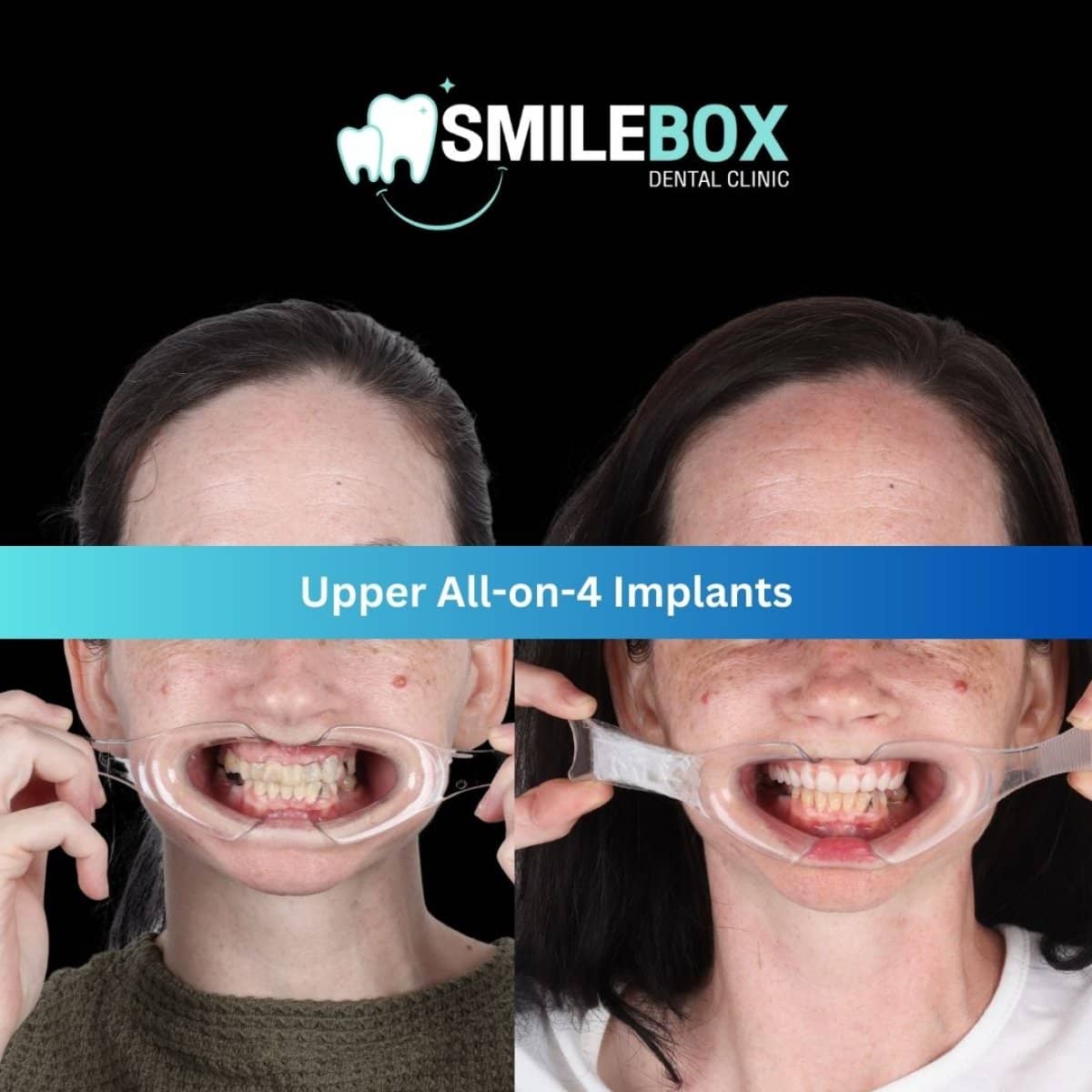 Case 11965 - All-on-4 dental implants