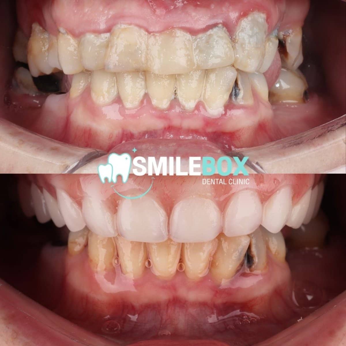 Case 11970 - All-on-4 dental implants