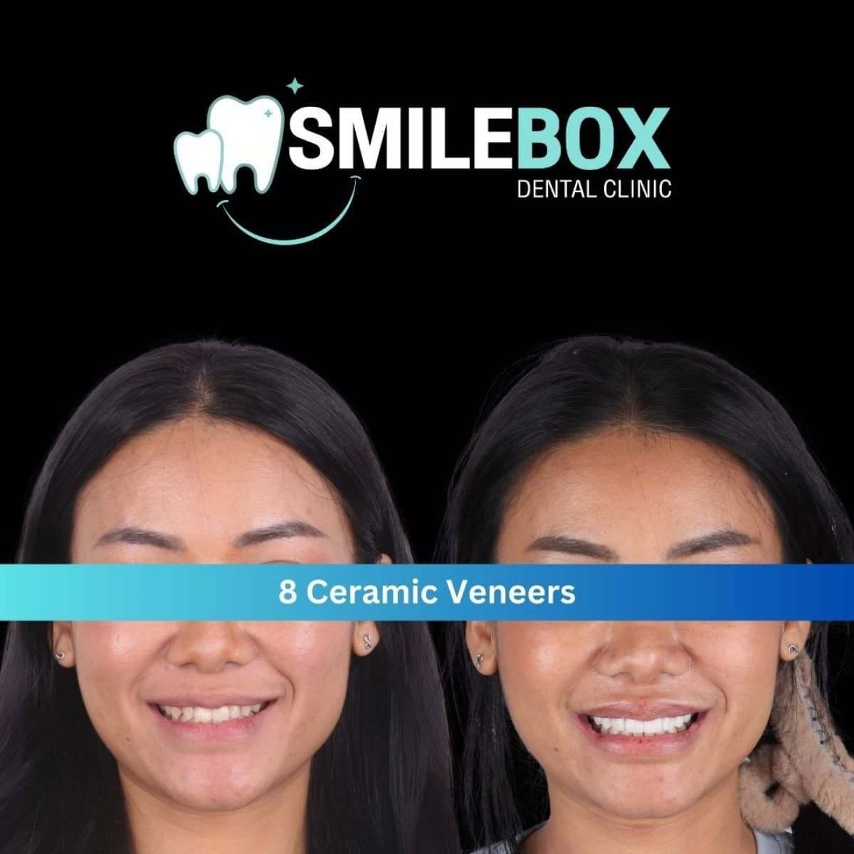 Case 11971 - results of 8 ceramic veneers