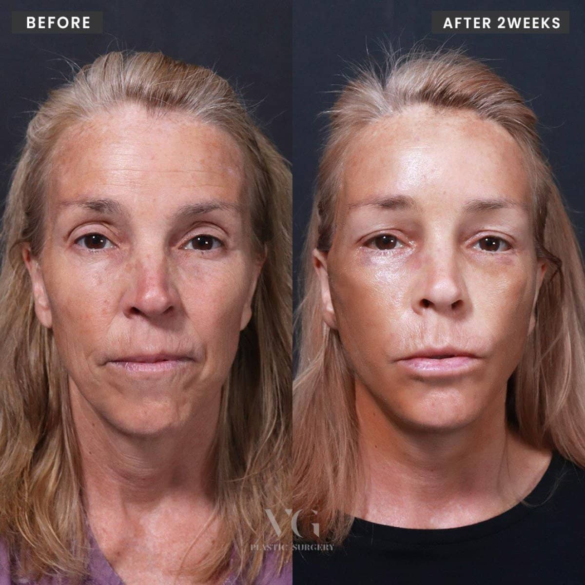 Case 11980 - results