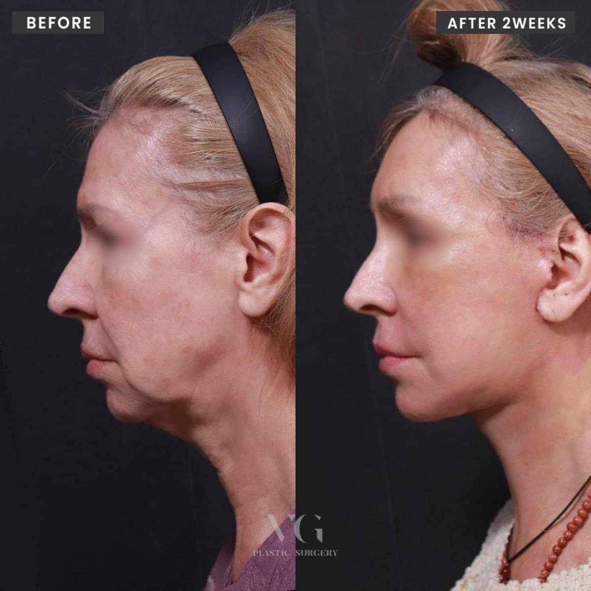 Case 11983 - upper eyelid surgery