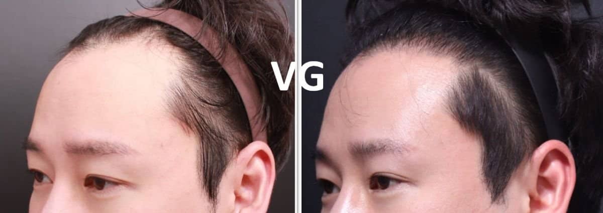 Case 12006 - FUE hair transplant
