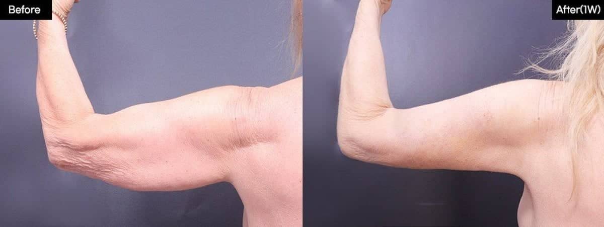 Case 12009 - Vaser liposuction arm