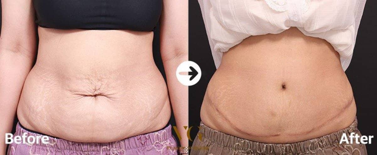 Case 12014 - abdominal liposuction