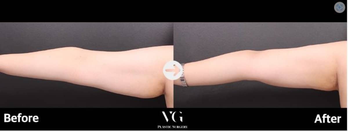 Case 12021 - upper arm liposuction