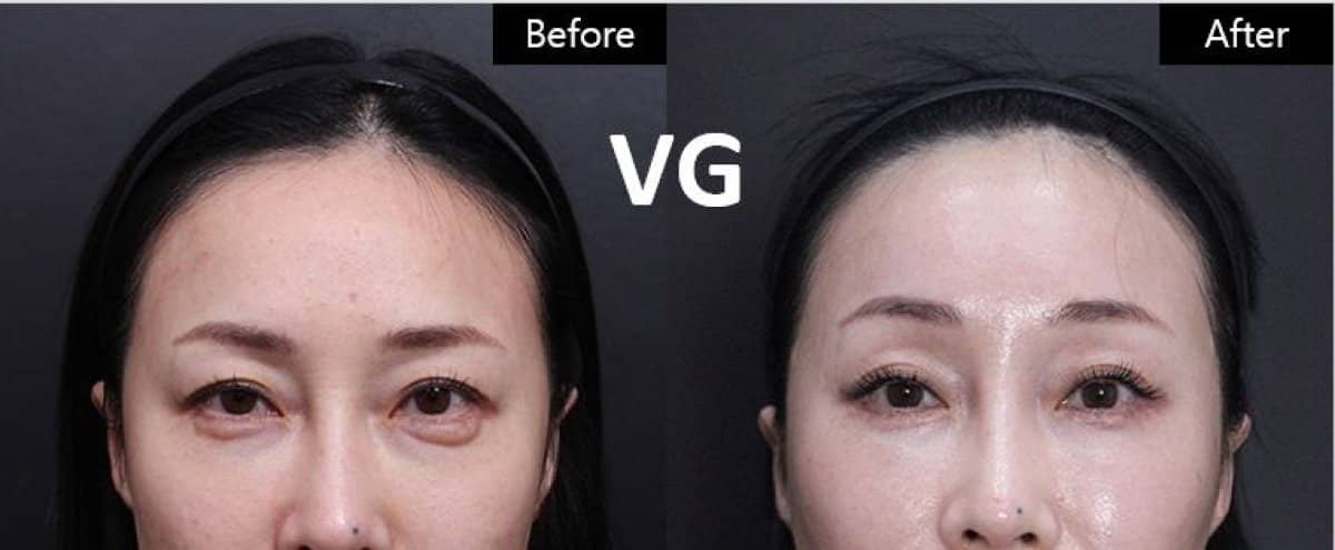 Case 12023 - droopy eyelid surgery