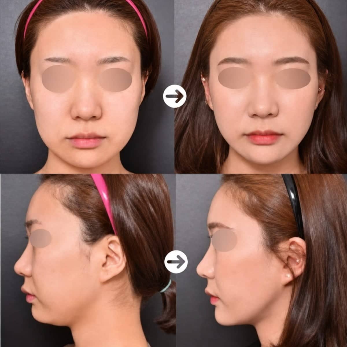 Case 12025 - nonsurgical facelift