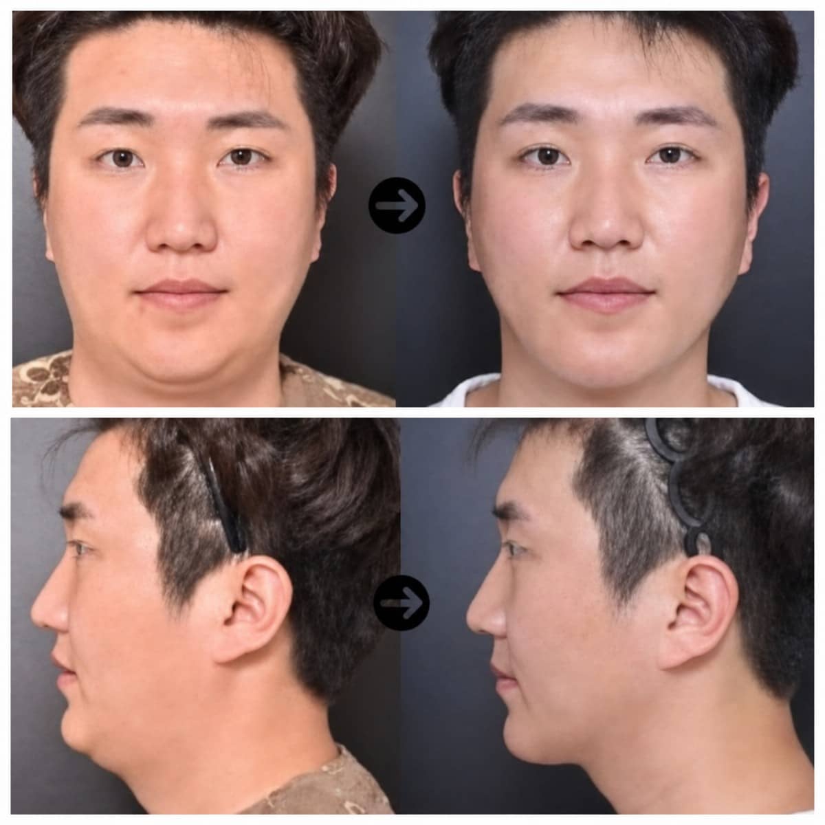 Case 12030 - buccal fat extraction
