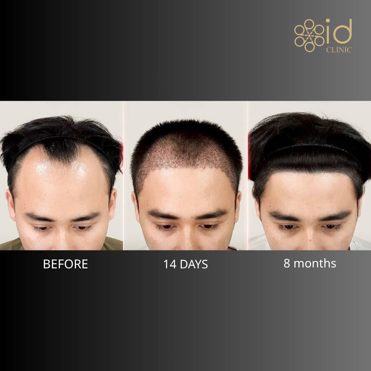 Case 12034 - hair transplant
