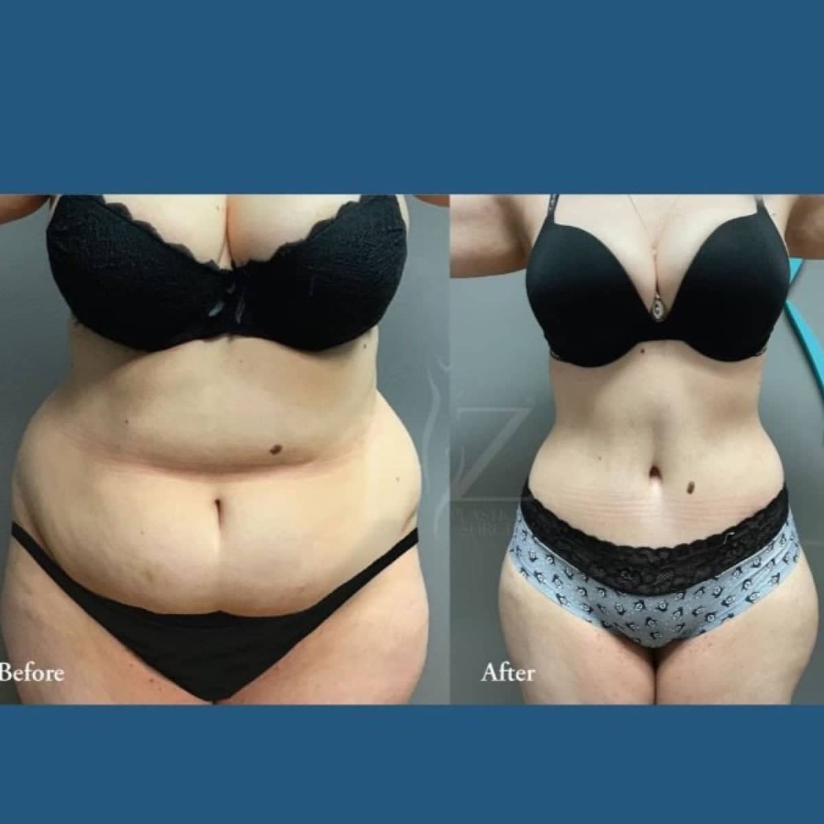 Case 12042 - tummy tuck and liposuction