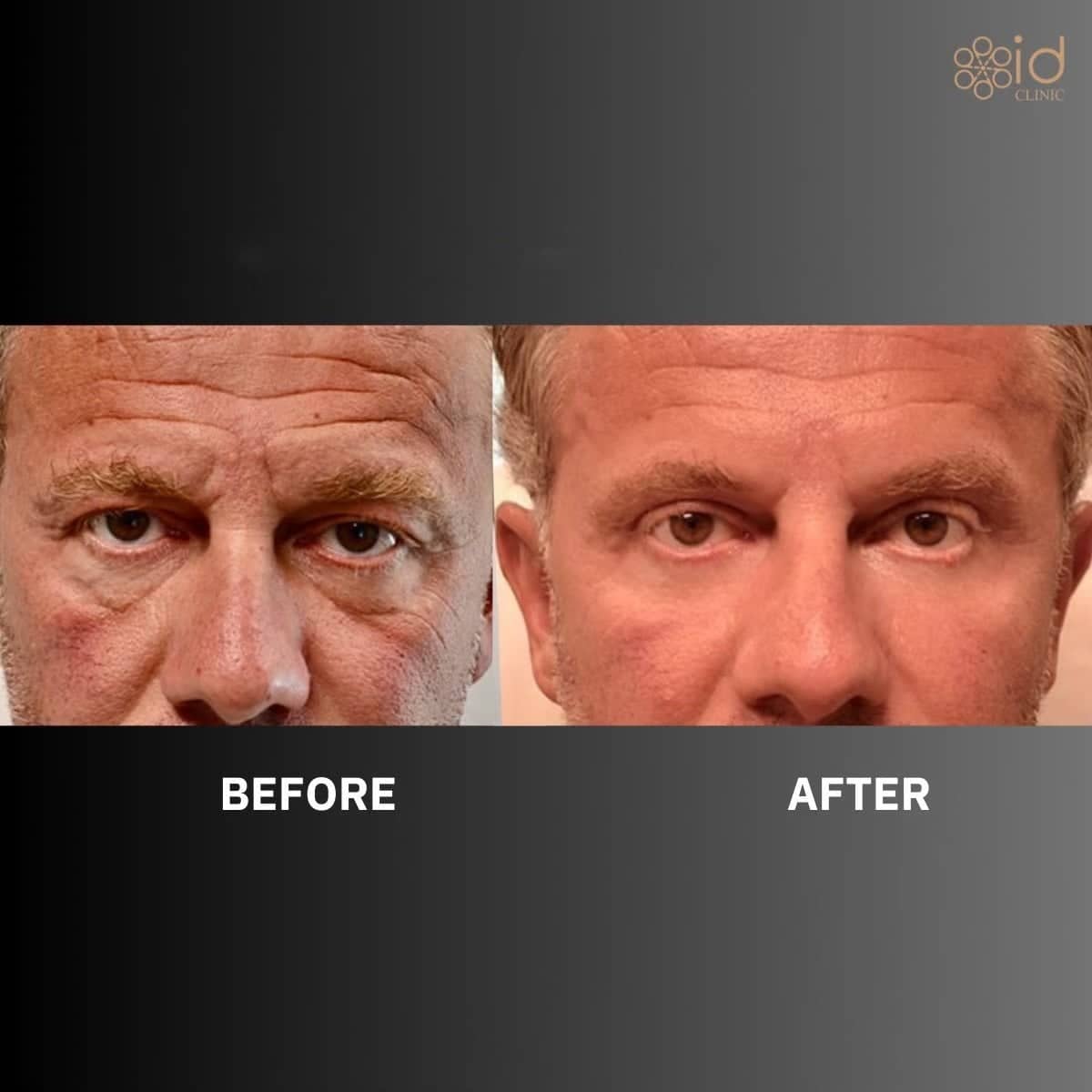 Case 12063 - liposuction for gynecomastia
