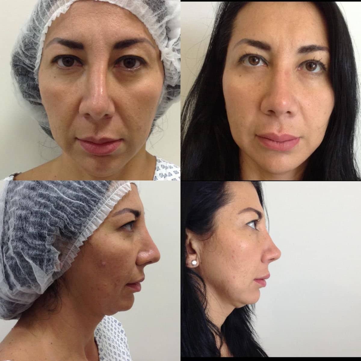 Case 12066 - ultrasonic rhinoplasty