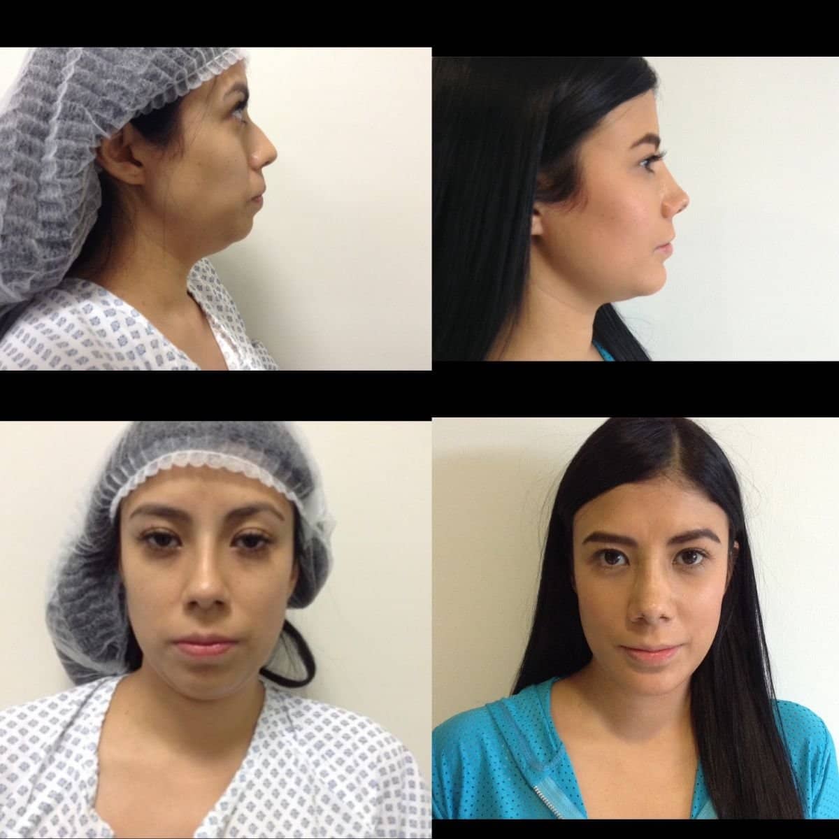 Case 12068 - ultrasonic rhinoplasty