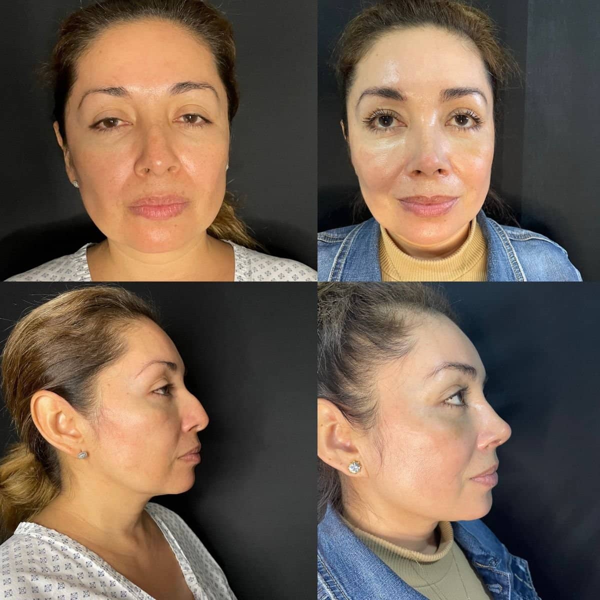 Case 12069 - ultrasonic rhinoplasty