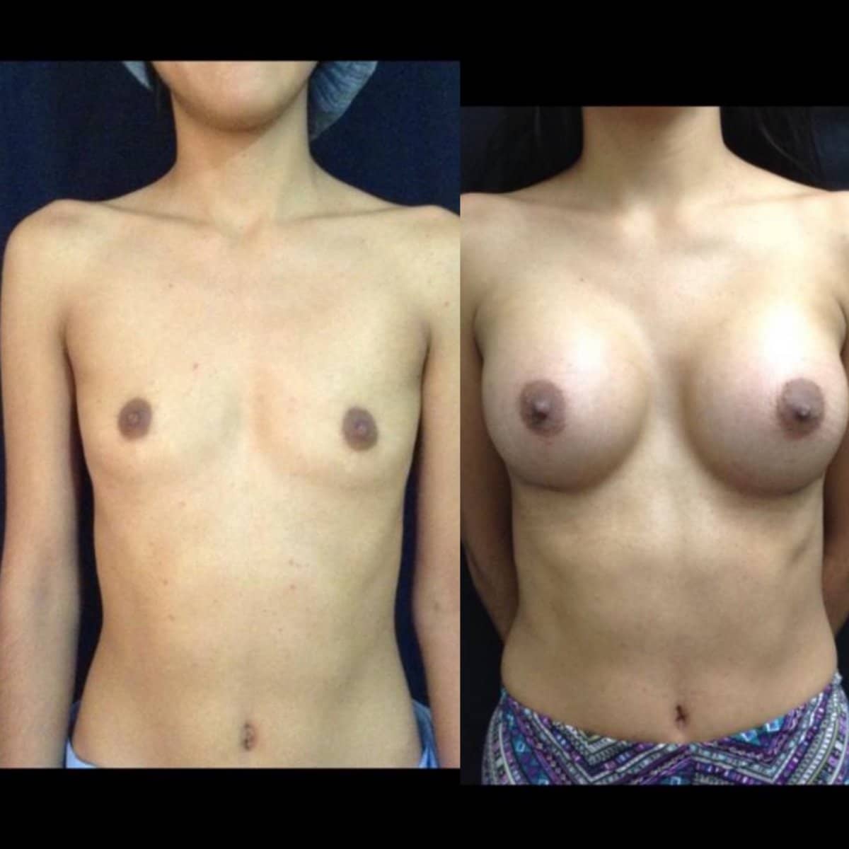 Case 12071 - breast augmentation