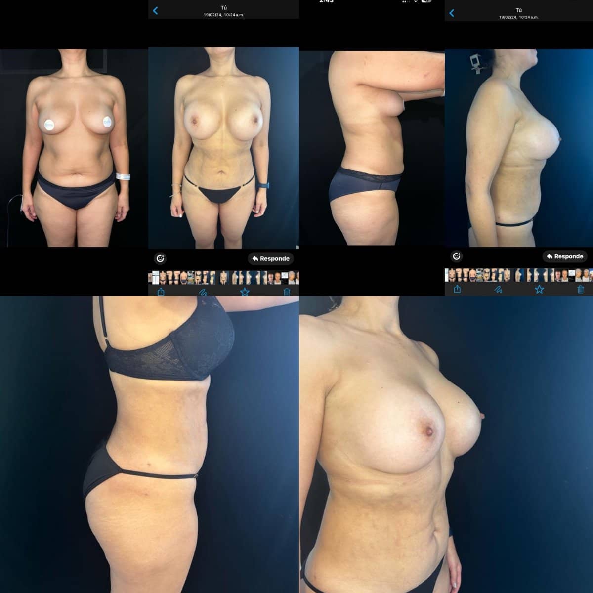 Case 12073 - liposuction