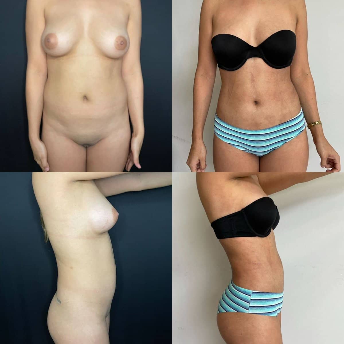 Case 12077 - Vaser liposuction