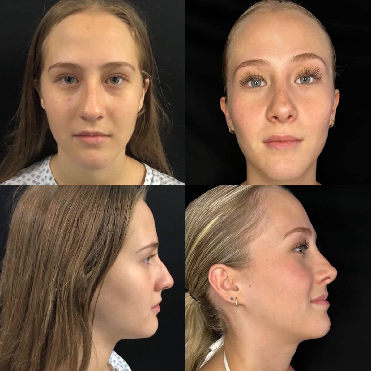 Case 12078 - ultrasonic rhinoplasty