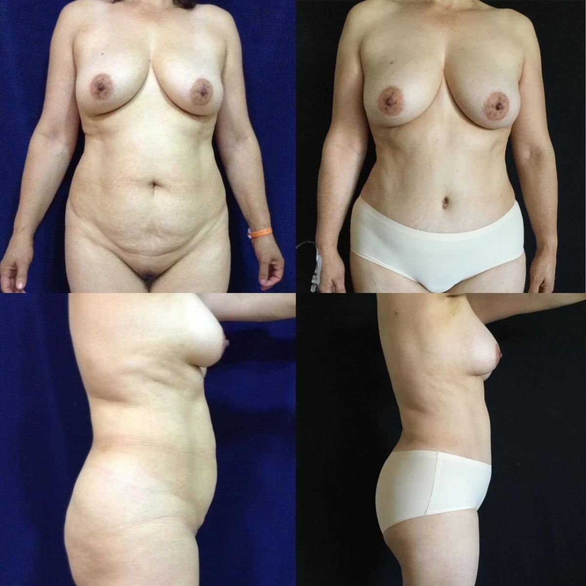 Case 12080 - tummy tuck