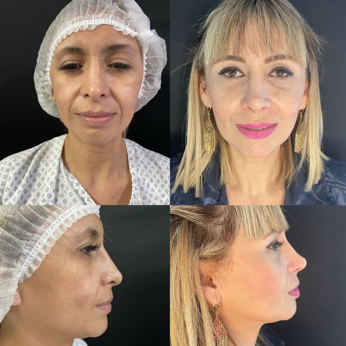 Case 12081 - ultrasonic rhinoplasty