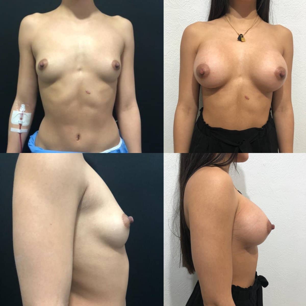 Case 12084 - breast augmentation