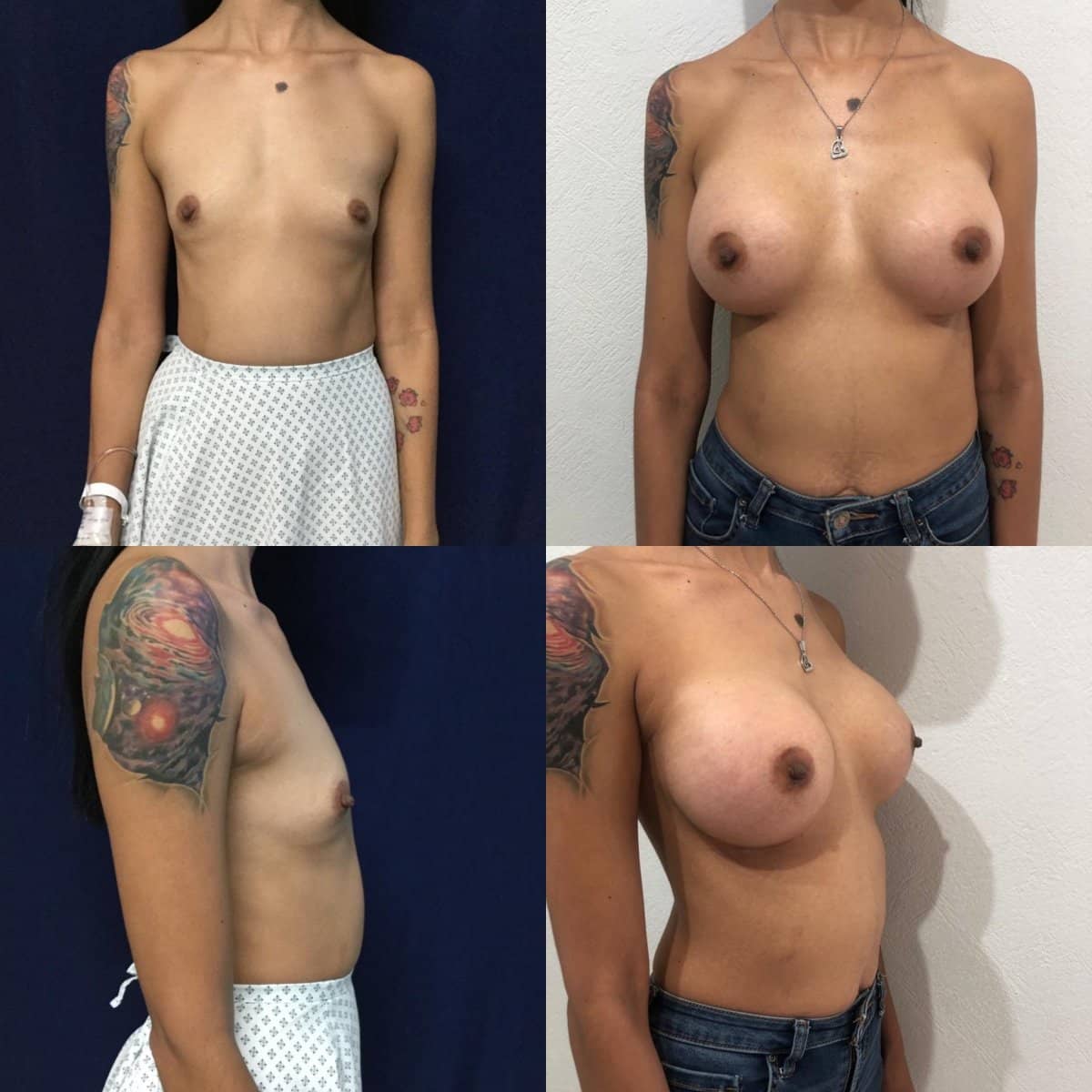 Case 12085 - breast augmentation