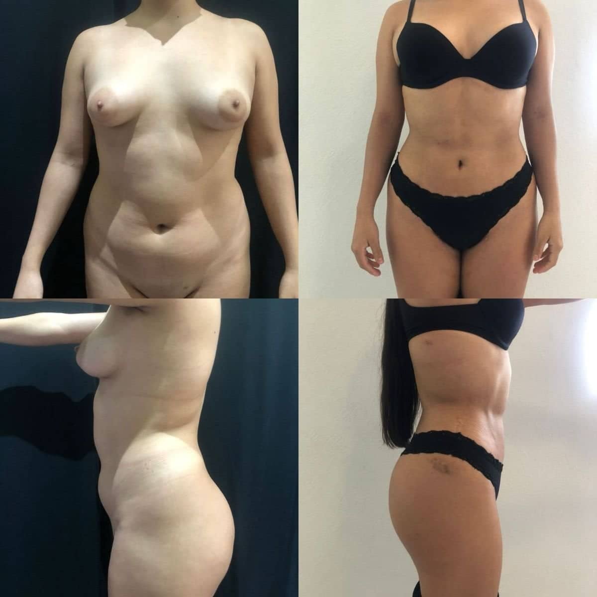Case 12087 - 360 liposuction