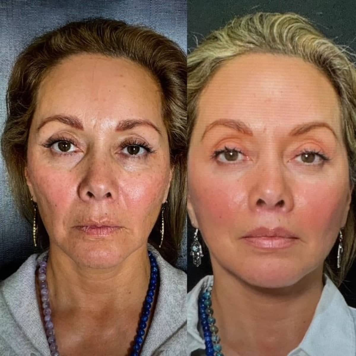 Case 12094 - results