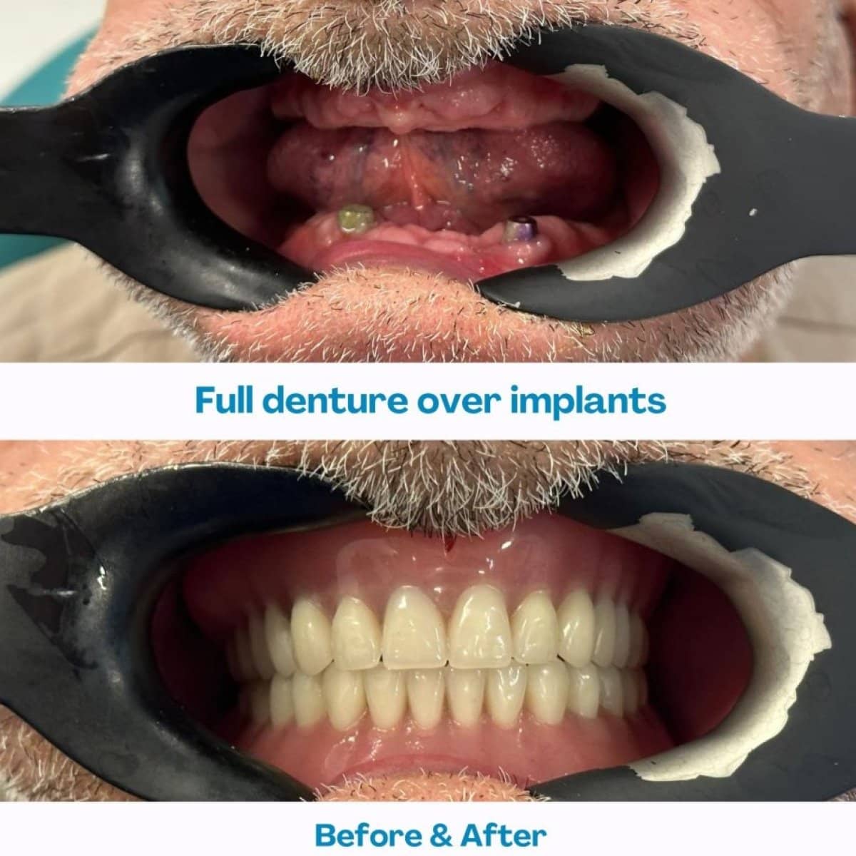 Case 12097 - full dentures over implants