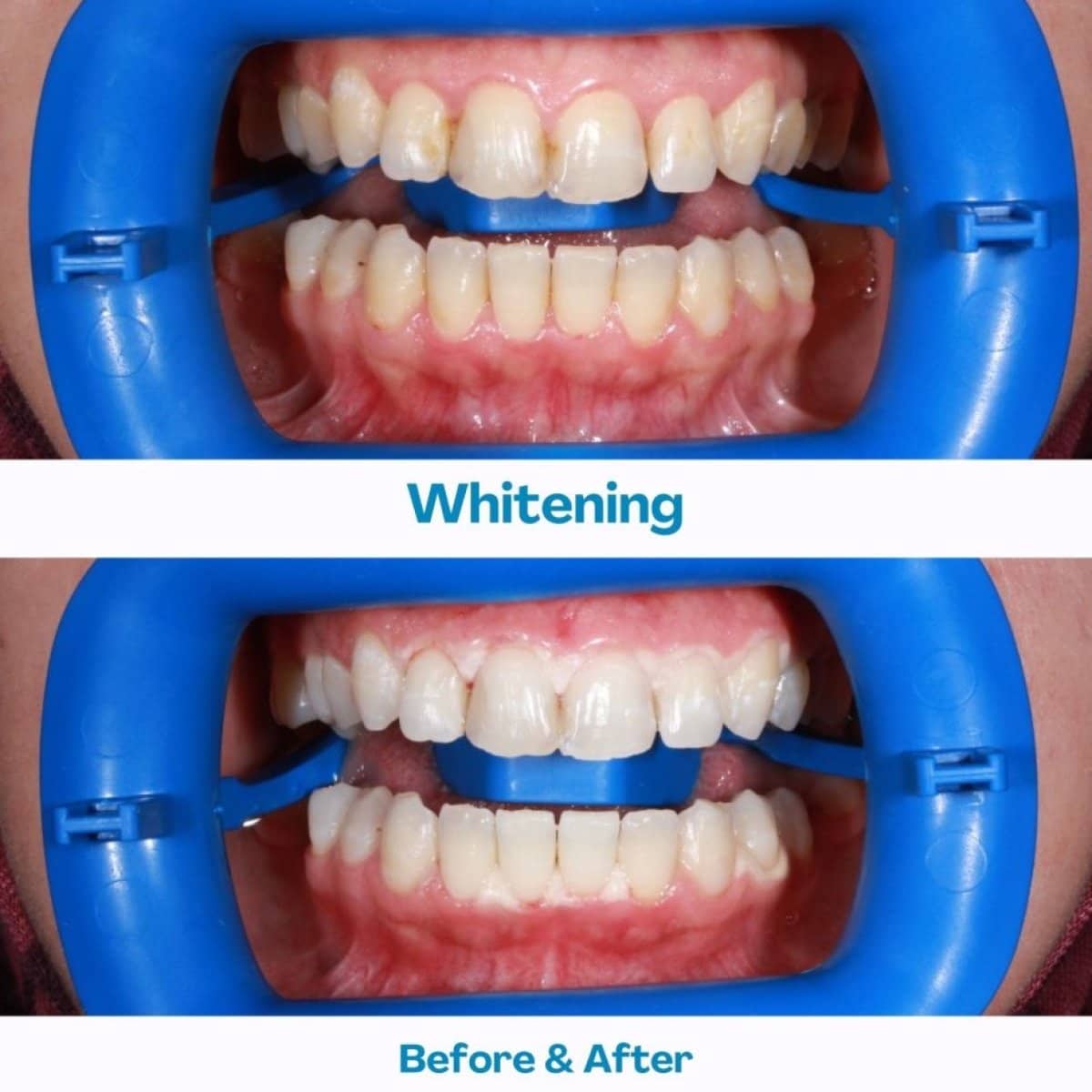 Case 12100 - laser teeth whitening