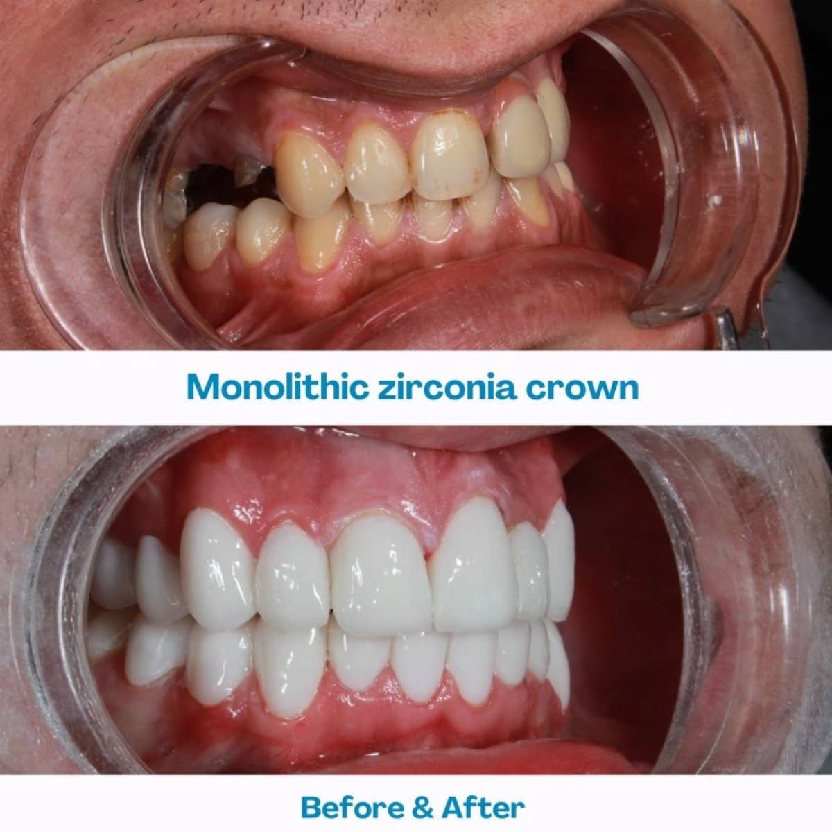 Case 12102 - zirconia crown