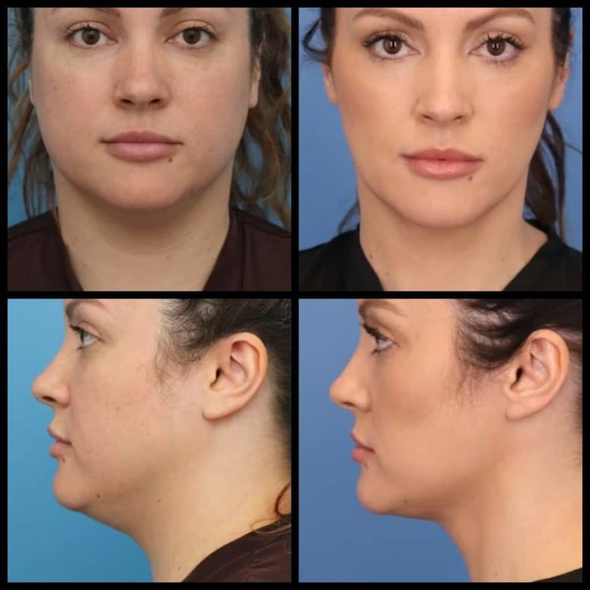 Case 12131 - fillers injection