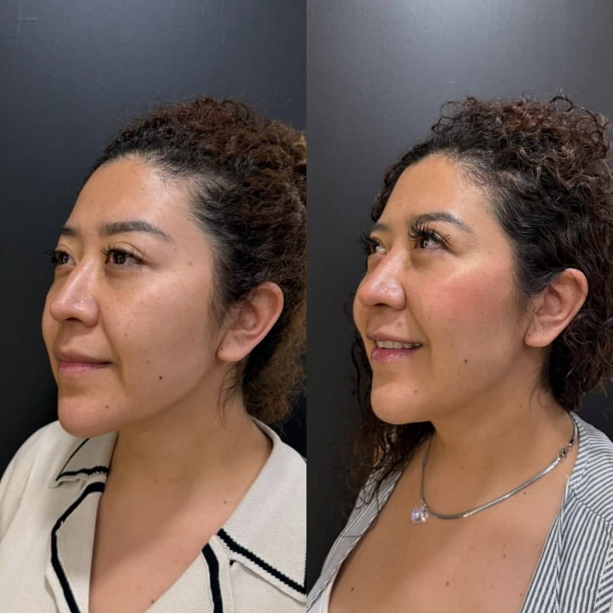 Case 12132 - chin liposuction