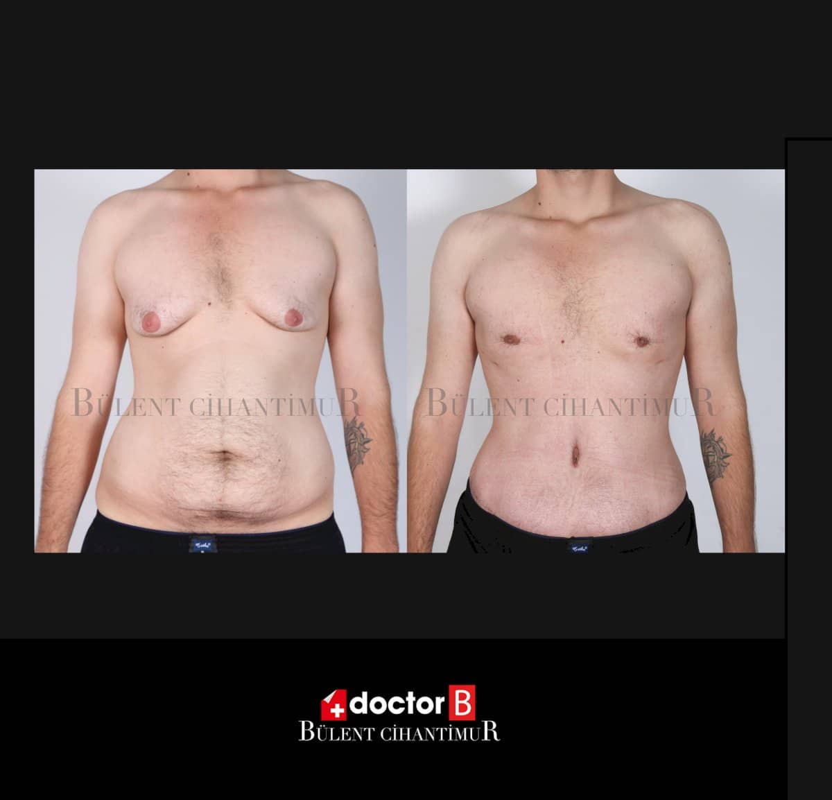 Case 12147 - gynecomastia surgery